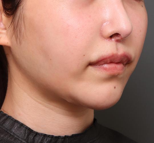 20代女性の二重アゴ筋肉縛り（ペリカン手術） After 症例写真