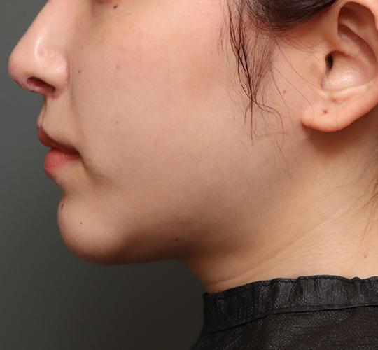 20代女性のエラ・アゴ・小顔 Before 症例写真