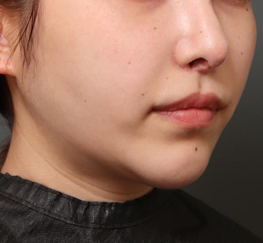20代女性の二重アゴ筋肉縛り（ペリカン手術） Before 症例写真