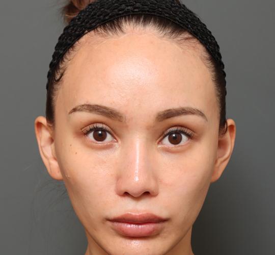 30代女性の額縮小 After 症例写真