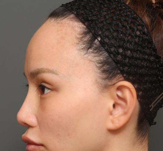 30代女性のエラ・アゴ・小顔 Before 症例写真