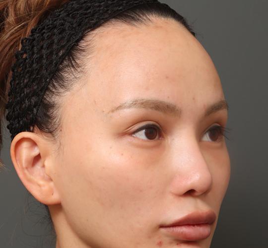 30代女性の額縮小 Before 症例写真