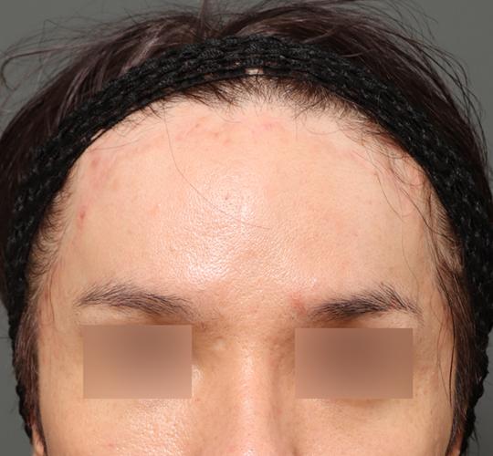 30代男性のエラ・アゴ・小顔 After 症例写真