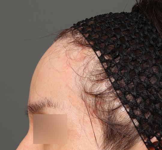 30代男性の生え際前進術 After 症例写真