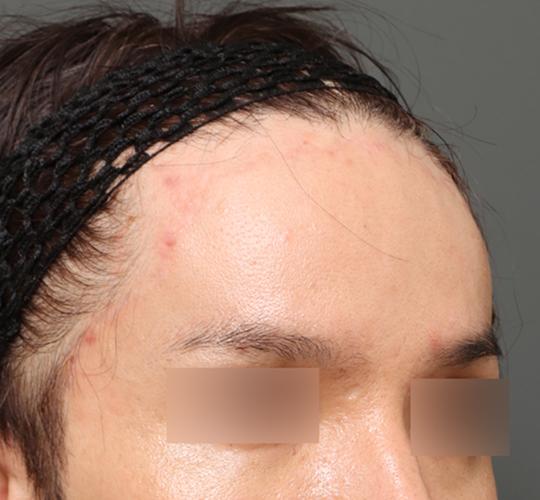 30代男性の生え際前進術 After 症例写真