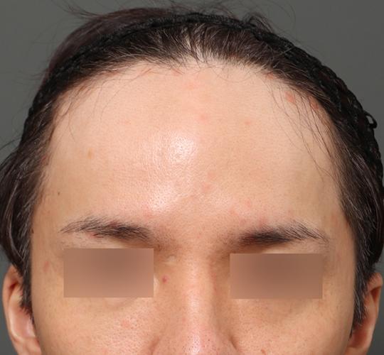 30代男性のエラ・アゴ・小顔 Before 症例写真