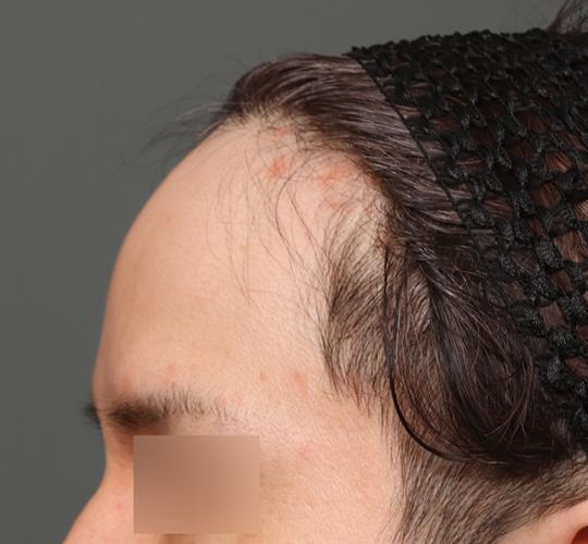 30代男性の生え際前進術 Before 症例写真