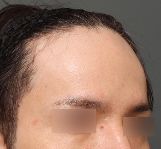 30代男性の生え際前進術 Before 症例写真