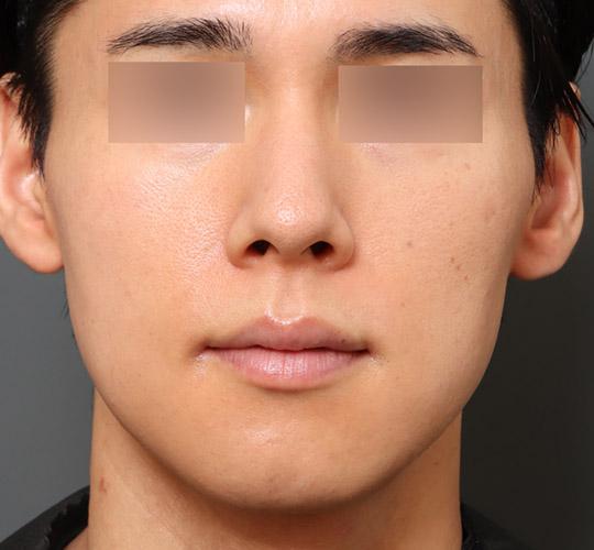 30代男性の顔の脂肪吸引  After 症例写真