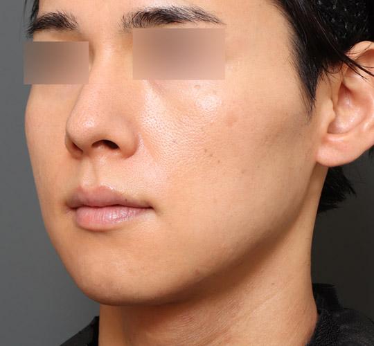 30代男性のエラ・アゴ・小顔 After 症例写真