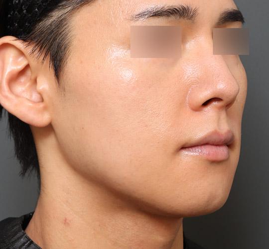 30代男性の顔の脂肪吸引  After 症例写真