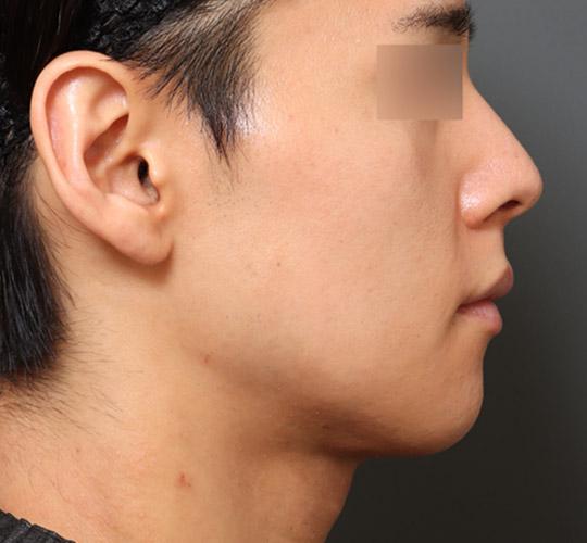 30代男性の顔の脂肪吸引  After 症例写真