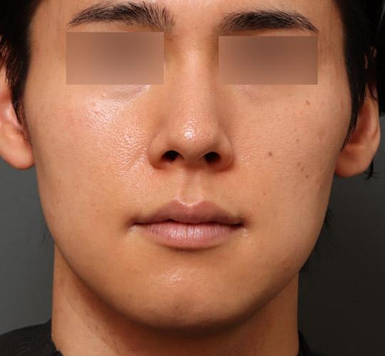 30代男性の顔の脂肪吸引  Before 症例写真