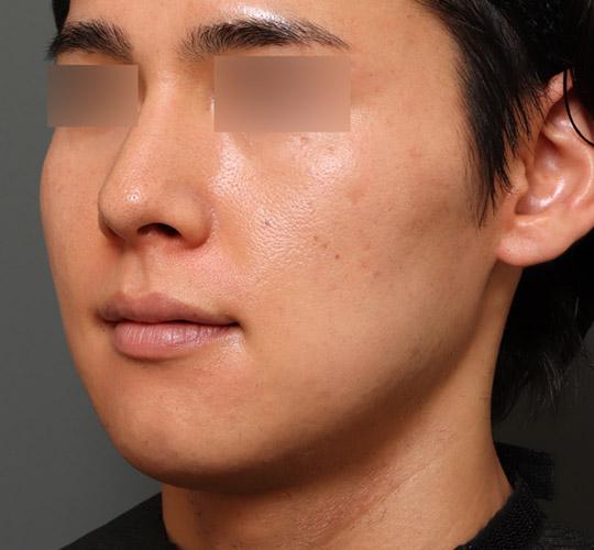 30代男性のエラ・アゴ・小顔 Before 症例写真