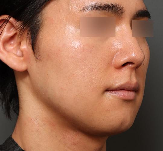 30代男性の顔の脂肪吸引  Before 症例写真