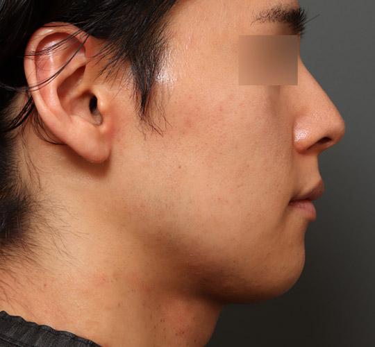 30代男性の顔の脂肪吸引  Before 症例写真