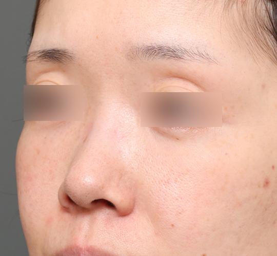 30代女性の3Dリポアイリフト  After 症例写真