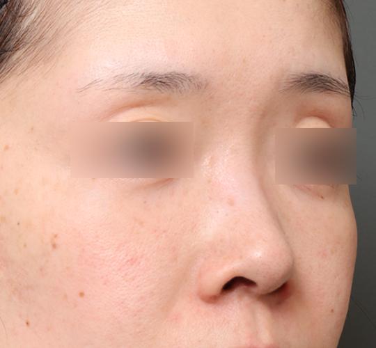 30代女性の3Dリポアイリフト  After 症例写真