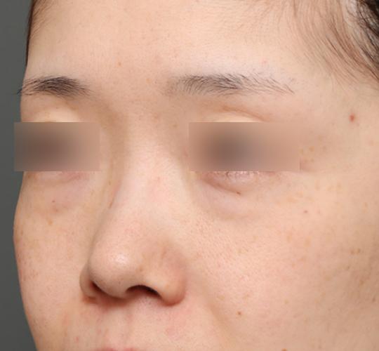 30代女性の3Dリポアイリフト  Before 症例写真