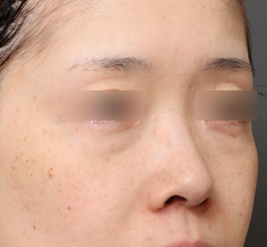 30代女性の3Dリポアイリフト  Before 症例写真