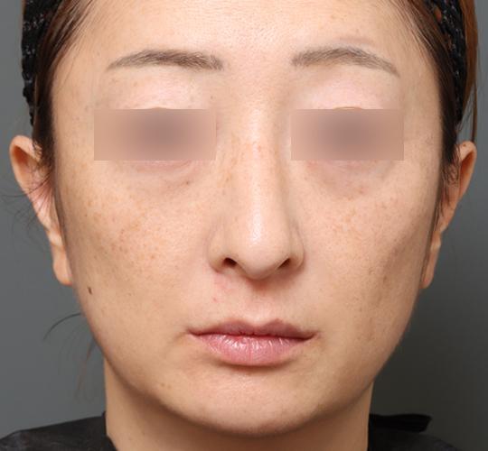 40代女性のワシ鼻整形(ハンプ削り) After 症例写真