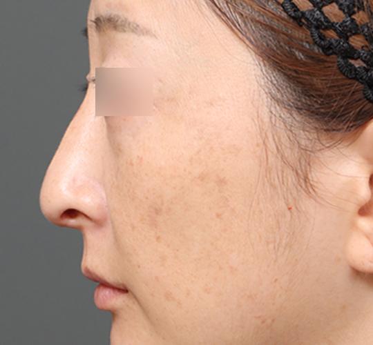 40代女性の鼻の整形 After 症例写真