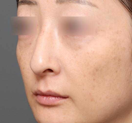 40代女性のワシ鼻整形(ハンプ削り) After 症例写真