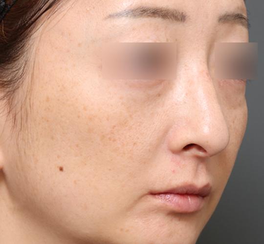 40代女性のワシ鼻整形(ハンプ削り) After 症例写真