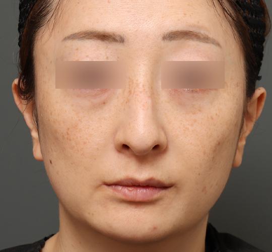 40代女性のワシ鼻整形(ハンプ削り) Before 症例写真