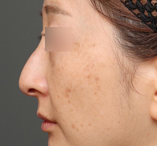 40代女性の鼻の整形 Before 症例写真