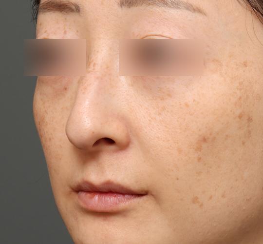 40代女性のワシ鼻整形(ハンプ削り) Before 症例写真