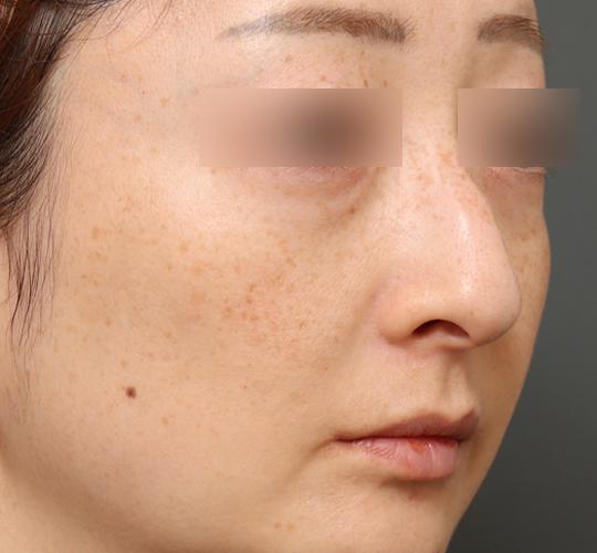 40代女性のワシ鼻整形(ハンプ削り) Before 症例写真