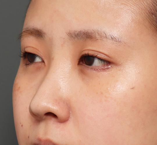 20代女性のタレ目・でか目形成 After 症例写真