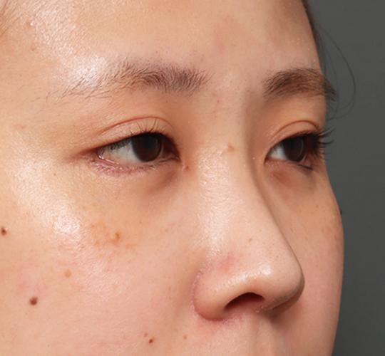 20代女性のタレ目・でか目形成 After 症例写真