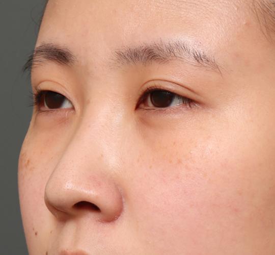 20代女性のタレ目・でか目形成 Before 症例写真