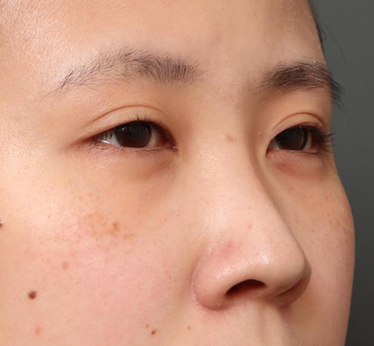 20代女性のタレ目・でか目形成 Before 症例写真