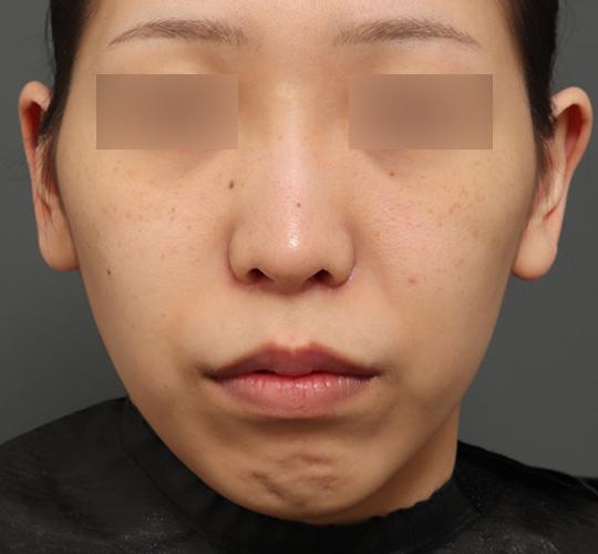 20代女性の人中短縮（リップリフト） After 症例写真