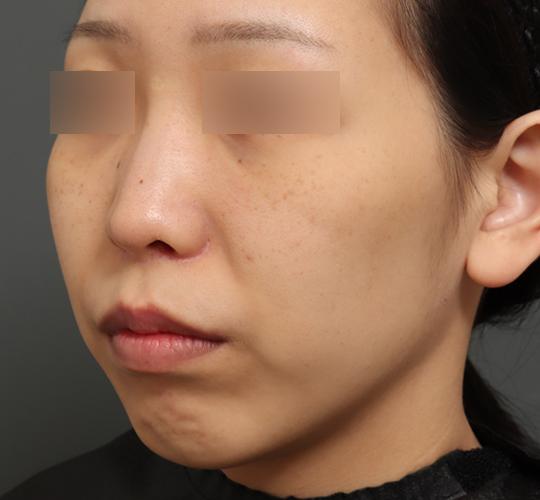 20代女性の鼻翼縮小（小鼻縮小） After 症例写真