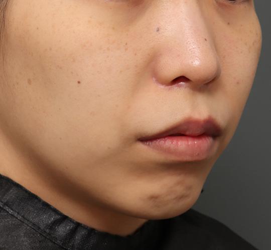 20代女性の人中短縮（リップリフト） After 症例写真