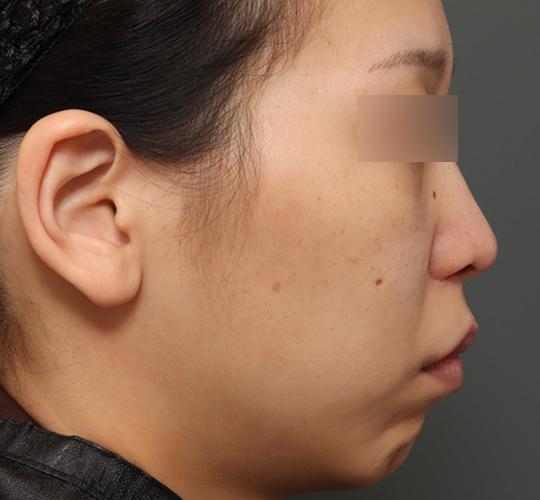 20代女性の人中短縮（リップリフト） After 症例写真