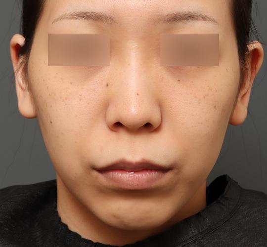20代女性の人中短縮（リップリフト） Before 症例写真