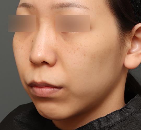 20代女性の鼻翼縮小（小鼻縮小） Before 症例写真