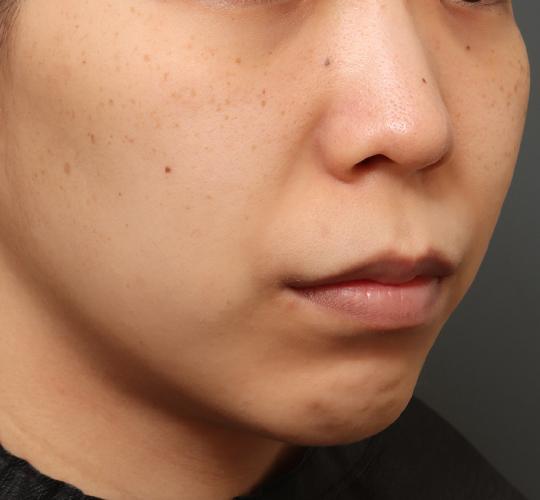 20代女性の人中短縮（リップリフト） Before 症例写真