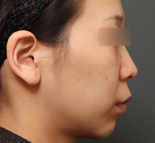 20代女性の人中短縮（リップリフト） Before 症例写真