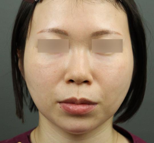 20代女性のヒアルロン酸注射（アゴ形成） After 症例写真