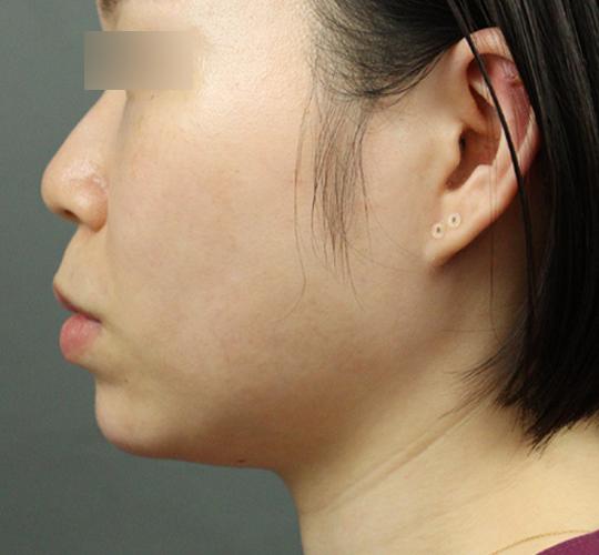 20代女性のヒアルロン酸注射 After 症例写真