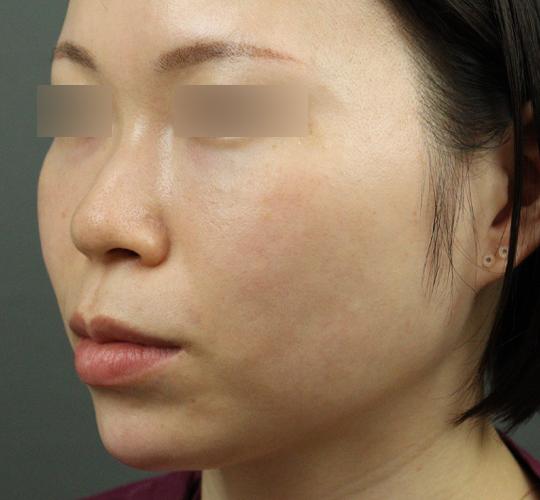 20代女性のヒアルロン酸注射（アゴ形成） After 症例写真