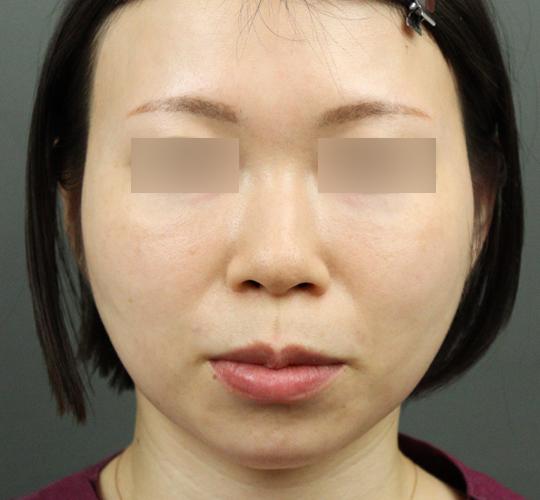 20代女性のヒアルロン酸注射（アゴ形成） Before 症例写真