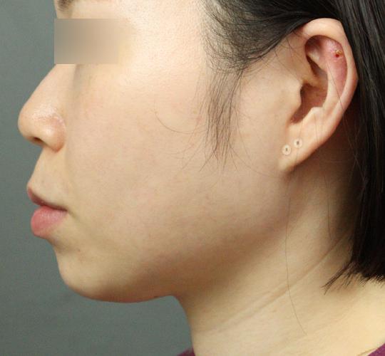 20代女性のヒアルロン酸注射 Before 症例写真