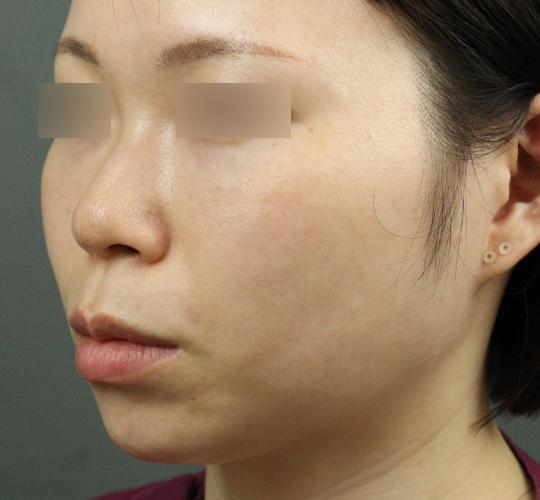 20代女性のヒアルロン酸注射（アゴ形成） Before 症例写真